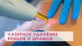 УДАЛЕНИЕ ШРАМОВ ЛАЗЕРОМ: процедура/ болезненность/ эффективность