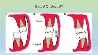 Management of Cross Bite