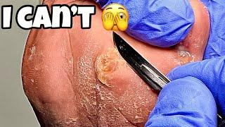 HARD CALLUS REMOVAL 