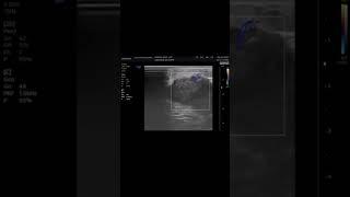 Fibroadema,  wider than tall with heterogeneous parenchyma echotexture BIOPSY IS ADVICE #ultrasound