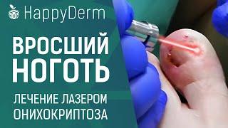 КАК УДАЛИТЬ ВРОСШИЙ НОГОТЬ БЕЗ БОЛИ,  ЛЕЧЕНИЕ ОНИХОКРИПТОЗА ЛАЗЕРОМ