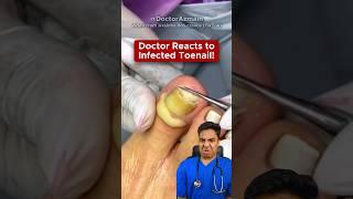  Doctor Reacts to Disgusting Nail Infection! (Paronychia Explained)