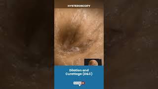 बच्चेदानी (Uterus) का Dilation और Curettage | Procedure for removing unwanted tissue in uterus