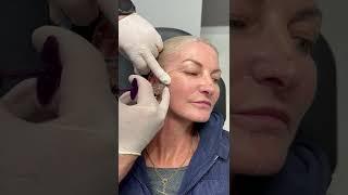 Cheek dermal filler | Newcastle Cosmetic Doctor | Performed by needle technique.