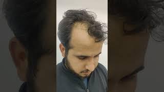 Hair transplant in indore | Hair transplant cost in indore