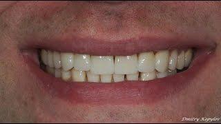 Виниры без обточки зубов. Veneers without teeth preparation. Emax. Carillas Dentales. 牙齿镶