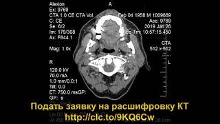 Расшифровка КТ шеи (второе мнение) с ишемическим инсультом  в теменной доле