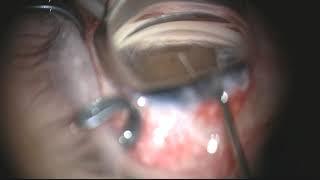 Dr. Bac Nguyen performs excisional goniotomy with KDB