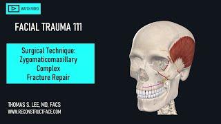 ZMC Fracture Repair Basics: Surgical Tips, Treatment Algorithm, FAQs! [111] Didactic