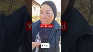Yuzi buzish #skincare #botoxm #travel #botoxcosmetic #beauty #botox #skincareroutine