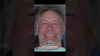 Full Mouth Restoration with All-on-Four Dental Implants in Tulsa, OK/#smilemakeover #shorts  #allon4