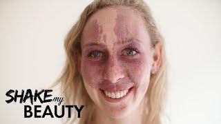 My Birthmark Is Beautiful | SHAKE MY BEAUTY