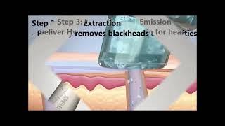 Bioskin 5-in-1 Hydro Dermabrasion