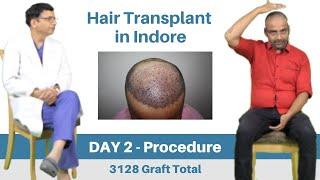 Hair Transplant Cost | Best Hair Transplant Indore | Best Hair transplant Clinic | Bhopal, Indore