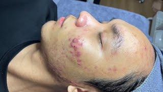 Acne & Cystic Removal For Boy 2024 | Acne With Vu Quynh Mi