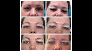 Blepharoplasty eyelid surgery for hooded eyes healing process. #blepharoplastysurgery #hoodedeyes