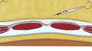 Surgical Anatomy Applied to the international classification of the abdominal wall planes (ICAP)