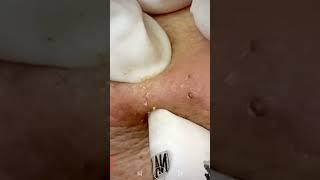 Skincare | Blackheads Removal #495 #tweezers skincare #blackheads blackheads