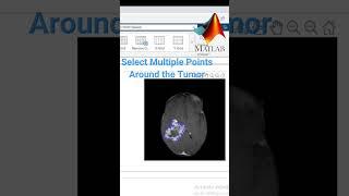 Extract Tumor by Image Segmentation MATLAB- DICOM image