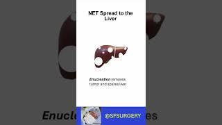 Surgery is Most Effective Therapy for Neuroendocrine Tumor Liver Metastases (NELMs)