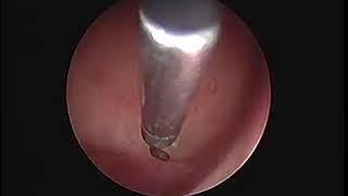 Hystroscopic tubal occlusion for hydrosalpinx