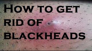 How to get rid of blackheads