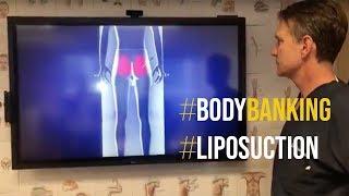 Alternative to Liposuction, Body Banking Procedure Explained by Dr. Steinbrech