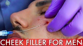 CHEEK FILLER FOR MEN | DR AYAD