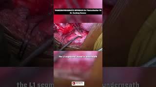 TRANSDIAPHRAGMATIC APPROACH for Thoracolumbar TB - Dr. Sandeep Sonone