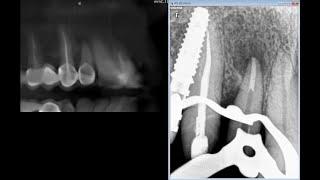 Upper anterior tooth large lesion one visit treatment with MTA