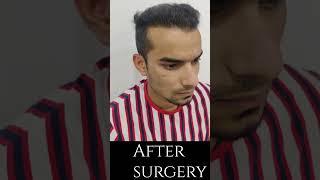 Hair transplant in indore | Amazing Hair transplant result #shorts #shortsfeed #viral #amazing