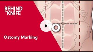 Behind the Knife - Ostomy Marking