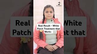 Vitiligo Skin Disease Treatment | Patient Testimonial for White Patch | #drsrideviesthetiques