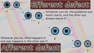 Pupil 2 | Characteristics of Afferent and Efferent Pupillary Defects