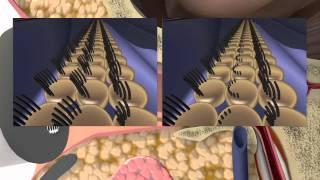 How hearing loss occurs...