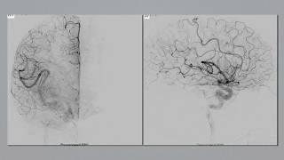 Motor cortex arteriovenous malformation