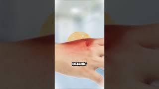 NEVER POP a BLISTER! Here’s WHY! 