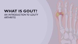 What is Gout? An Introduction to Gouty Arthritis (1 of 6)
