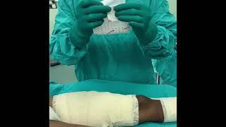 Using Hypafix