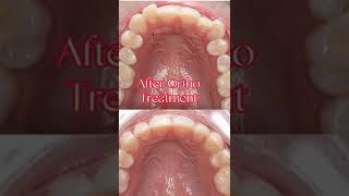 How to Move the tooth to straight in Their Original line|Orthodontic Treatment|Fixed Braces|
