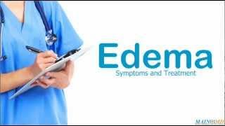 Edema: Symptoms and Treatment