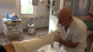 Attelle plâtrée pour une rupture du tendon d'Achille