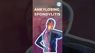 Ankylosing Spondylitis | Arthritis of Spine BY Dr Himanshu Gaur #spine #spondylitis #arthritis