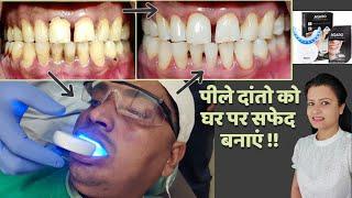 पीले दांतो को घर पर सफेद  बनाएं | agaro dazzle instant teeth whitening