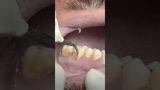 Teeth  Scaling tartar & calculus #dentist