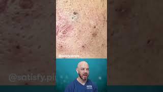 HUGE blackhead removal in this video! (credit: @satisfy.pimple on TT)#foryou #satisfying #blackhead