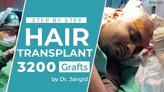 Best Hair Transplant in Delhi | Dr Jangid | Hair Transplant Cost in Delhi | SkinQure Hair Transplant