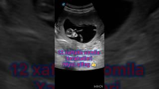 3 oylik xomila raqsi #pregnancytips #skrining #baby #ultrasound #dopplerultrasound #pregnant #dopler