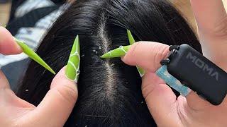 Ultimate Flake Hunt: Long Nails & Tweezers ASMR Scalp Sleep Aid