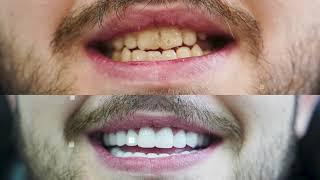 Mr Alfie Hollywood Smile - E-Max Crown